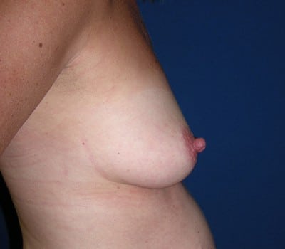 Before Image: 325cc Silicone Gel Implants - other