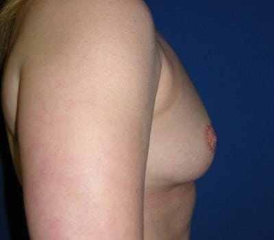 Before Image: 450cc Silicone Gel Implants - other