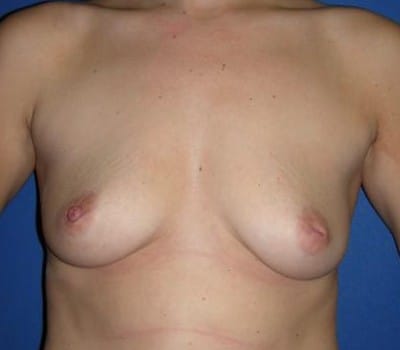 Before Image: 400cc Bilateral Silicone Gel Implant - front