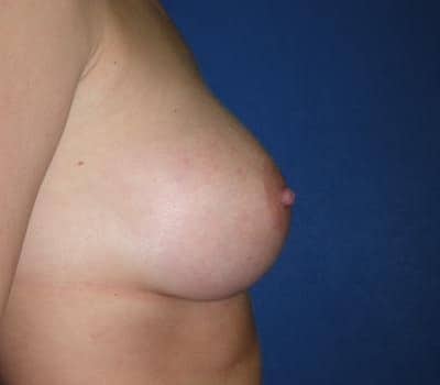 After Image: 400cc Bilateral Silicone Gel Implant - other