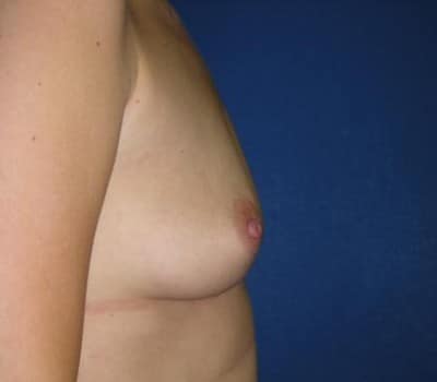 Before Image: 400cc Bilateral Silicone Gel Implant - other