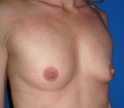 Before Image: 350cc Silicone Gel Implant - other