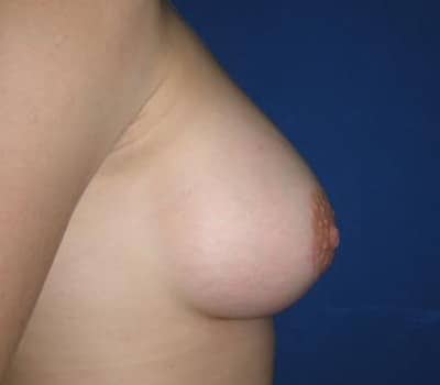 After Image: 425cc Silicone Gel Implants - other