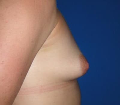 Before Image: 425cc Silicone Gel Implants - other