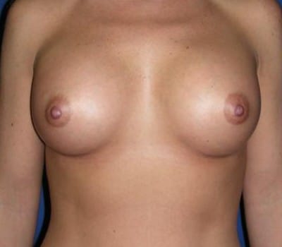 After Image: 350cc Silicone Gel Implants - front