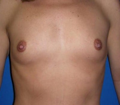 Before Image: 350cc Silicone Gel Implants - front