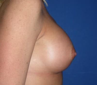 After Image: 350cc Silicone Gel Implants - other