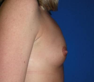 Before Image: 350cc Silicone Gel Implants - other