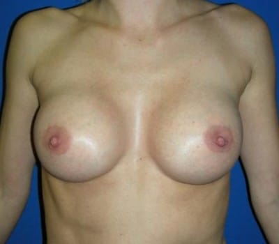 After Image: 280cc Saline Implant - front