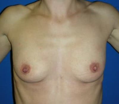 Before Image: 280cc Saline Implant - front