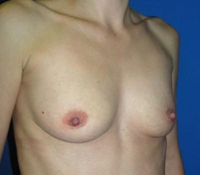 Before Image: 280cc Saline Implant - other