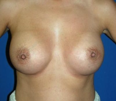 After Image: 380cc & 370cc Saline Implant - front
