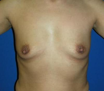 Before Image: 380cc & 370cc Saline Implant - front