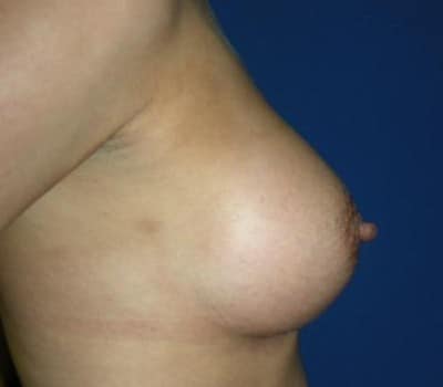 After Image: 380cc & 370cc Saline Implant - other