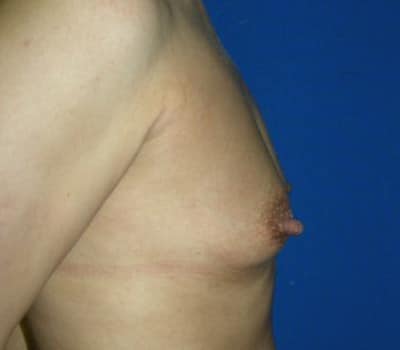 Before Image: 380cc & 370cc Saline Implant - other