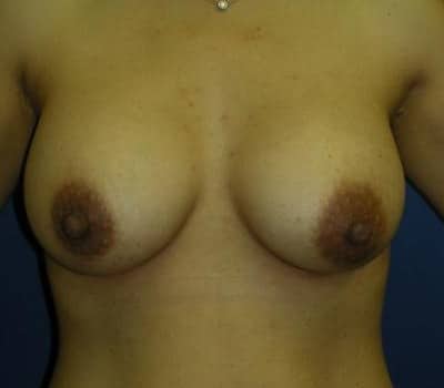 After Image: 350cc Saline Implant - front
