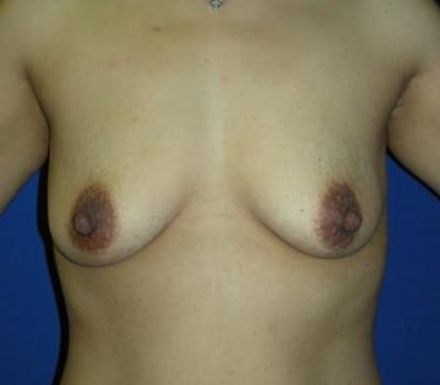 Before Image: 350cc Saline Implant - front