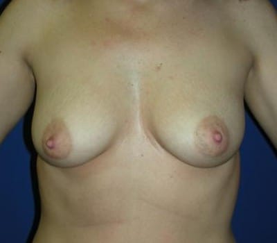 Before Image: 265cc Gel Implant - front