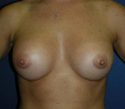 After Image: Saline Breast Aug - front