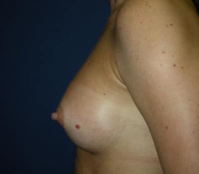 After Image: Saline Breast Aug - front