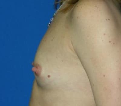 Before Image: Saline Breast Aug - front
