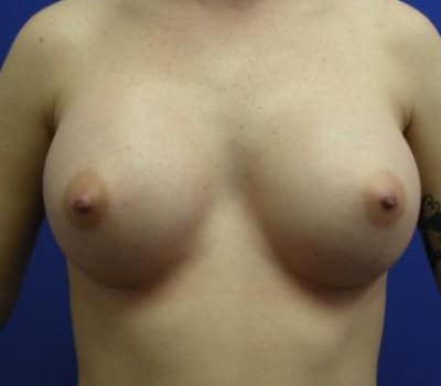 After Image: 360cc Saline Implants - front