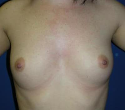 Before Image: 360cc Saline Implants - front