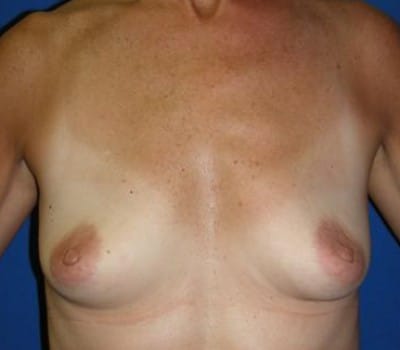 Before Image: 339cc Silicone Gel Implants - front
