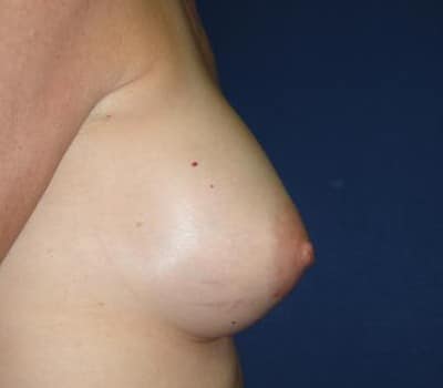 After Image: 339cc Silicone Gel Implants - other