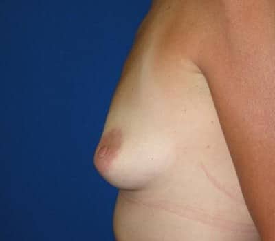 Before Image: 339cc Silicone Gel Implants - other