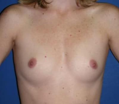 Before Image: 339cc Silicone Gel Implants - front