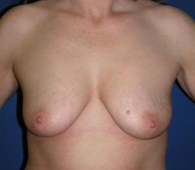 Before Image: 350cc Saline Implants - front