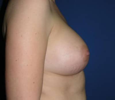 After Image: 339cc Silicone Gel Implants - other
