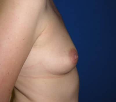 Before Image: 339cc Silicone Gel Implants - other