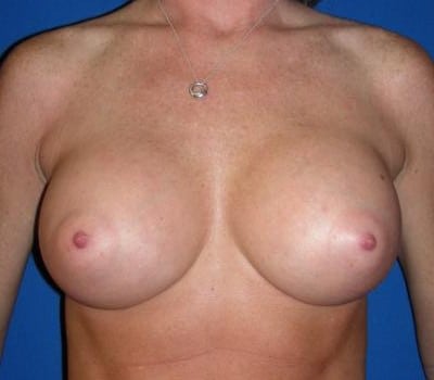 After Image: 371cc Silicone Gel Implants - front