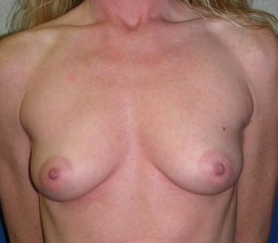 Before Image: 371cc Silicone Gel Implants - front