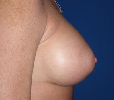 After Image: 371cc Silicone Gel Implants - other
