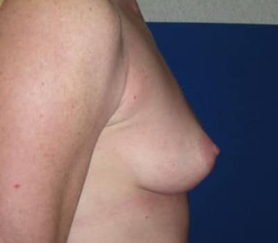 Before Image: 371cc Silicone Gel Implants - other