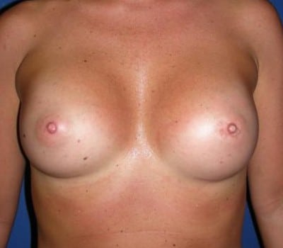 After Image: 304cc Silicone Gel Implants - front