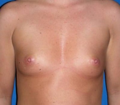Before Image: 304cc Silicone Gel Implants - front