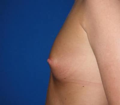 Before Image: 304cc Silicone Gel Implants - other