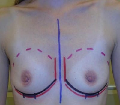 Before Image: 250cc Saline Implants - front