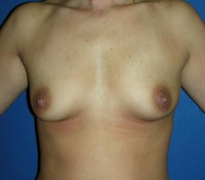 Before Image: 340cc Implants - front