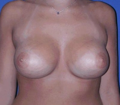 After Image: 340cc Round Smooth Saline Implants - front