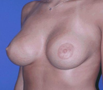 After Image: 340cc Round Smooth Saline Implants - other