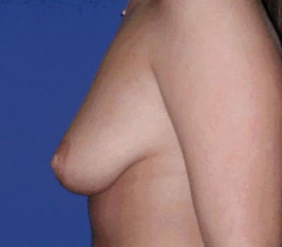 Before Image: 340cc Round Smooth Saline Implants - other