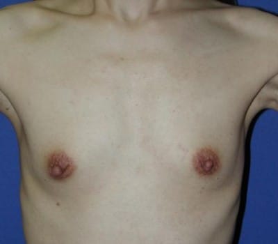 Before Image: 250cc Saline Implant - front