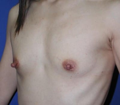 Before Image: 250cc Saline Implant - other