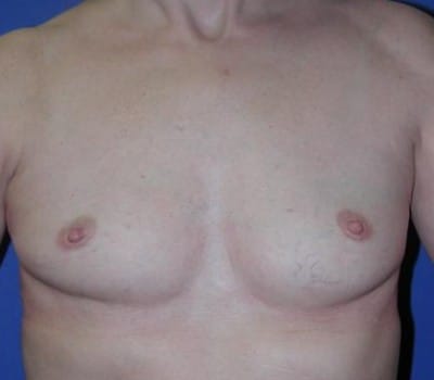 Before Image: Bilateral Breast Implants - front