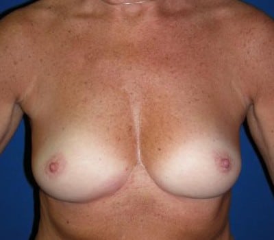 Before Image: 325cc Bilateral Silicone Gel Implant - front
